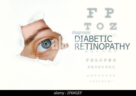 Frau`s Auge schaut durch ein zerrtes Loch in Papier, Augentest mit den Worten Diabetische Retinopathie auf der linken Seite. Vorlage für das Konzept der Augenerkrankung. Weißer Hintergrund. Stockfoto